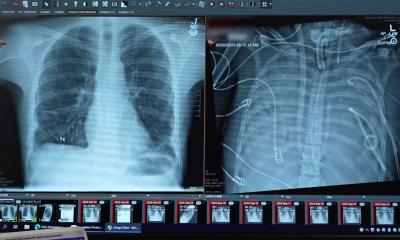 “Artificial lungs” keep patient alive for 48 hours until transplant