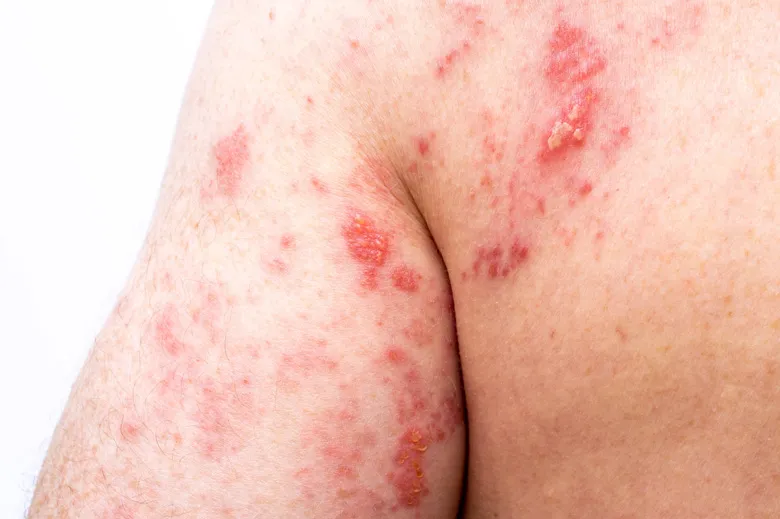 Patients with eczema at increased shingles risk, study shows