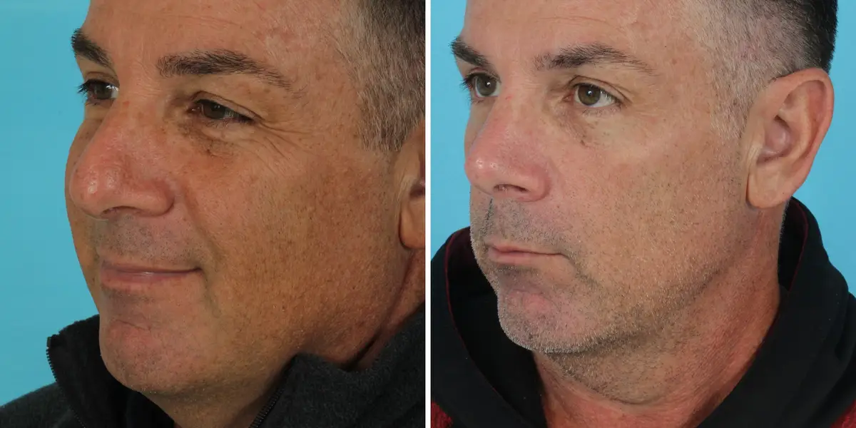 I’m a retired firefighter. I spent $14,000 on plastic surgery in my 50s, and I’m not ashamed.
