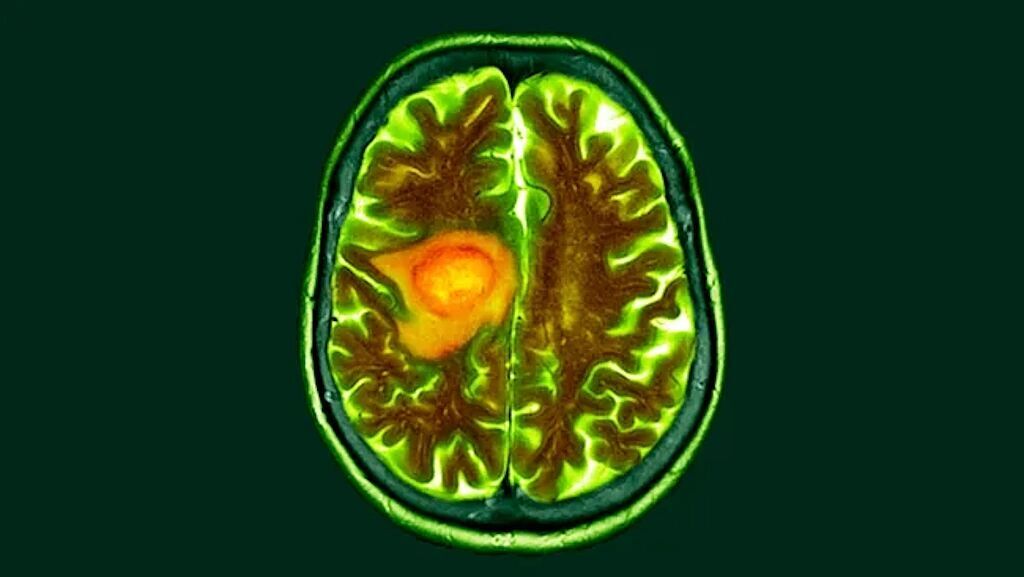 Promising preliminary research finds diet change could make brain cancer easier to treat