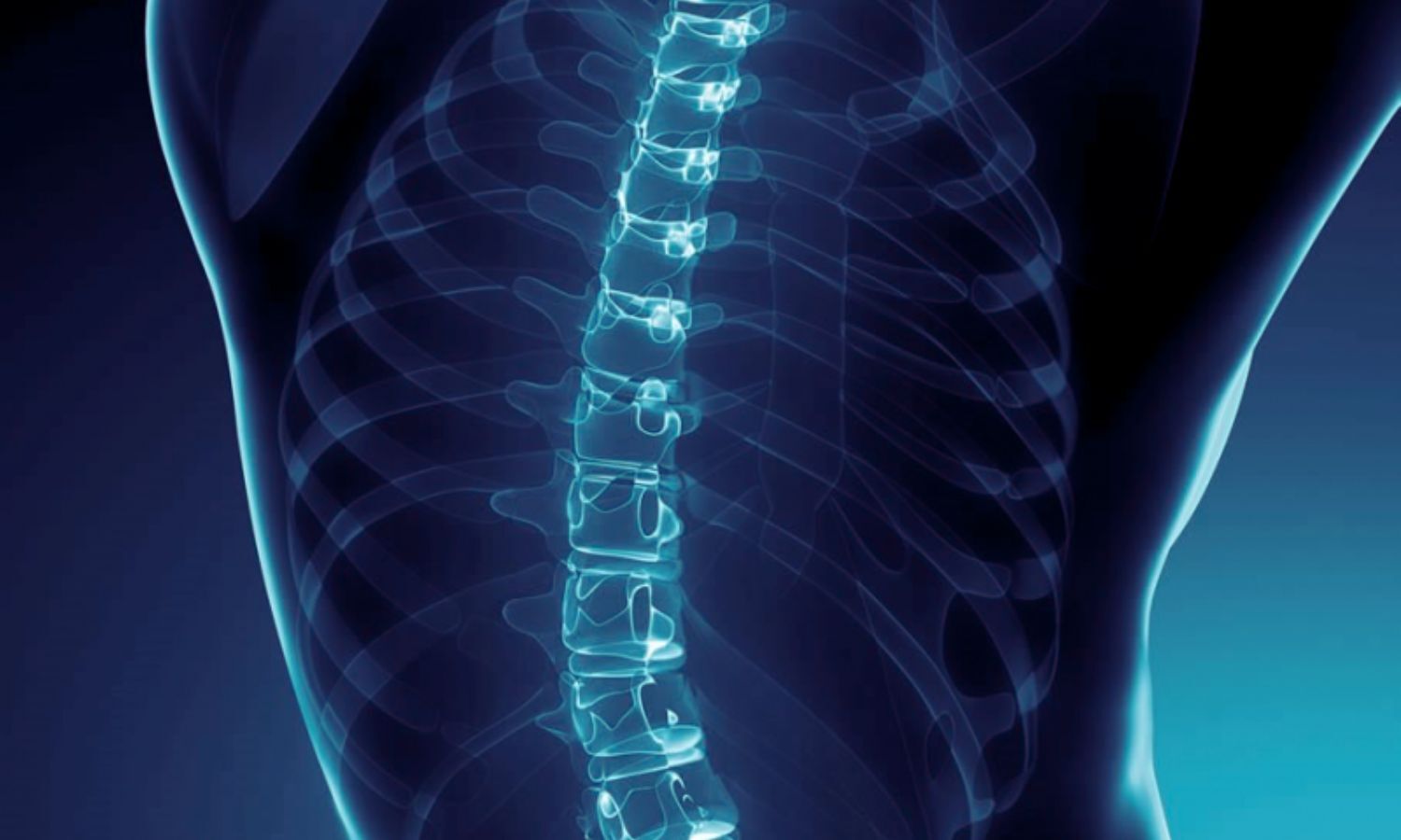 Robotic Guidance Improves Pedicle Screw Placement Accuracy during  precision spinal surgery: Study