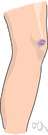 contusion