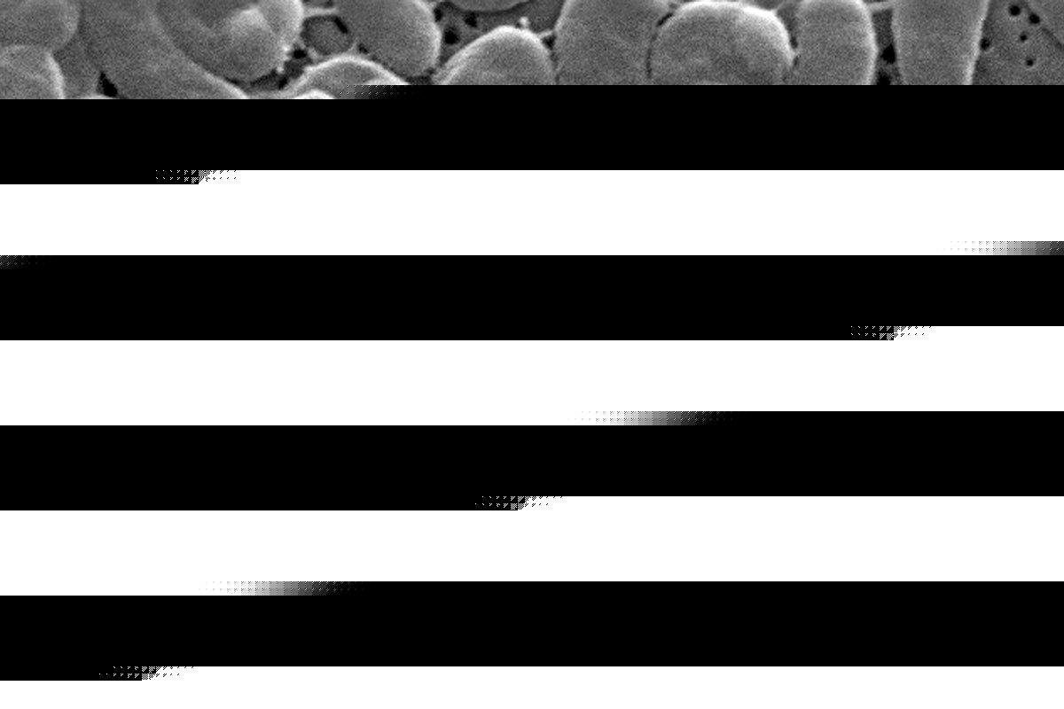 A ‘flesh-eating bacteria’ is spreading worldwide. Here’s how to protect yourself