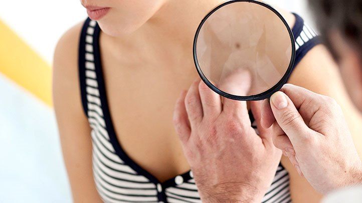 What Are the Signs and Symptoms of Skin Cancer?