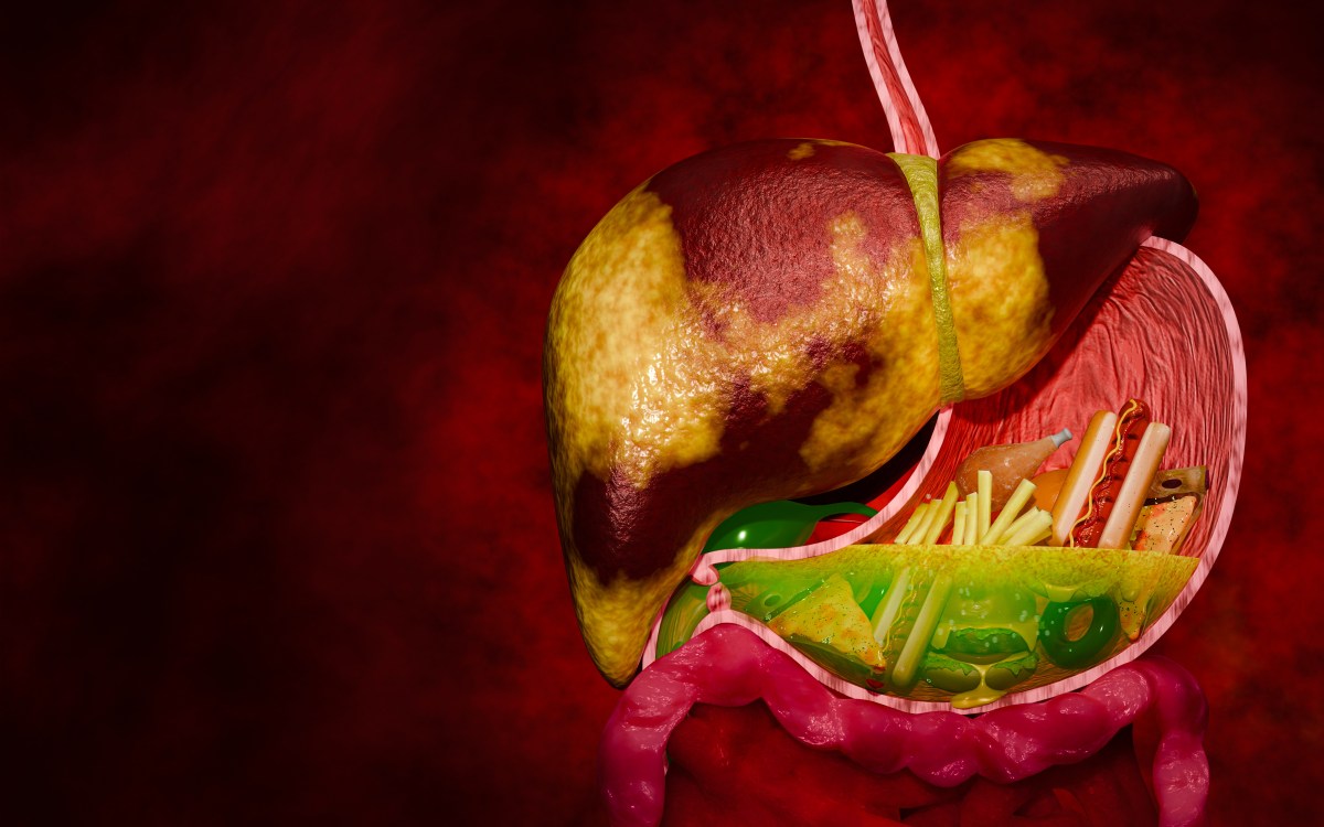 Cómo sanar el hígado graso: alimentos clave, qué evitar y las 6 señales que no debes ignorar