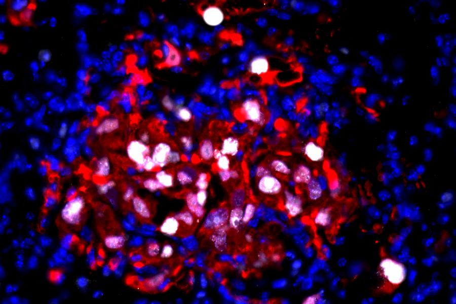 Chemotherapy Drug Accidentally Wakes Sleeping Cancer Cells