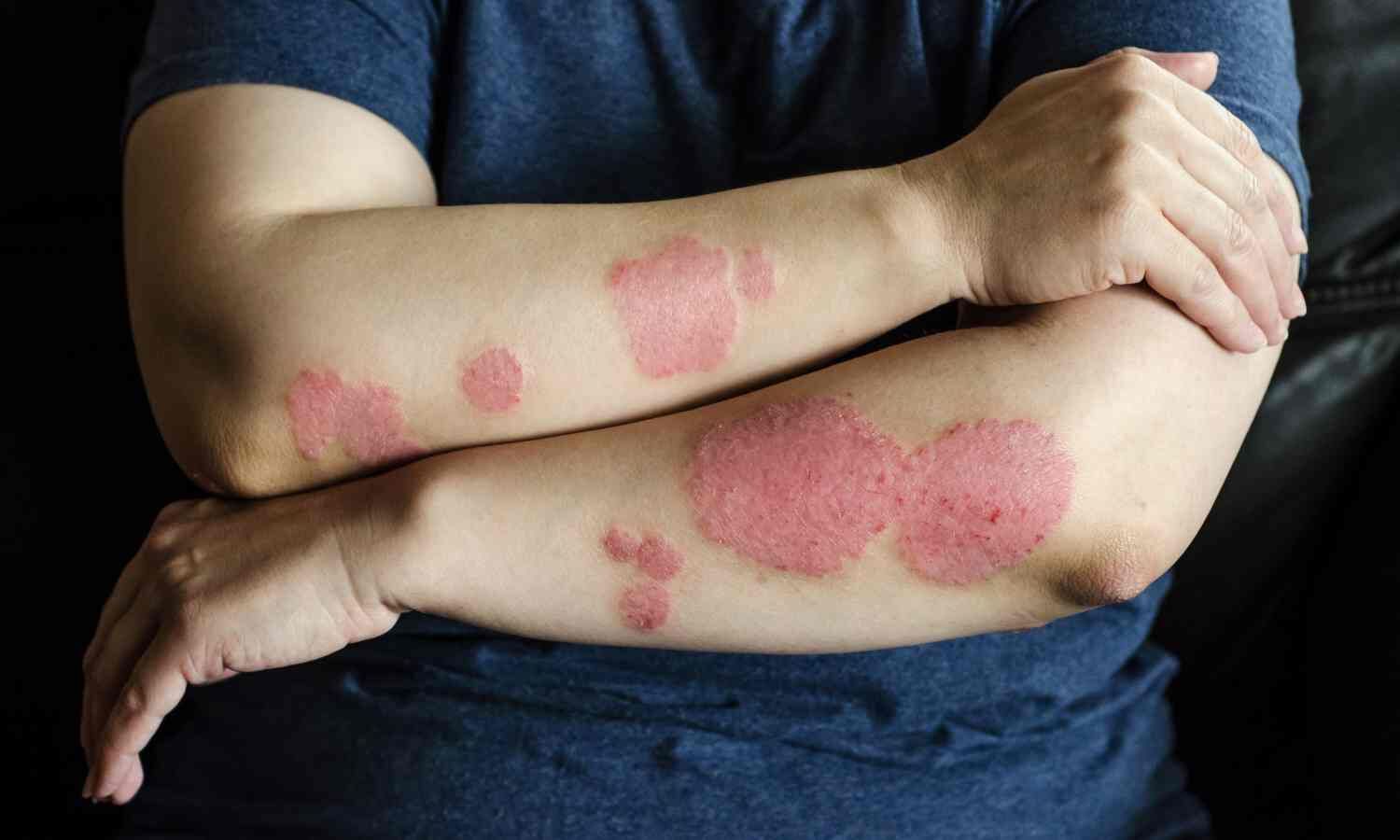 Standard Psoriasis Treatment Significantly Reduces Insomnia and Improves Sleep Quality: Study