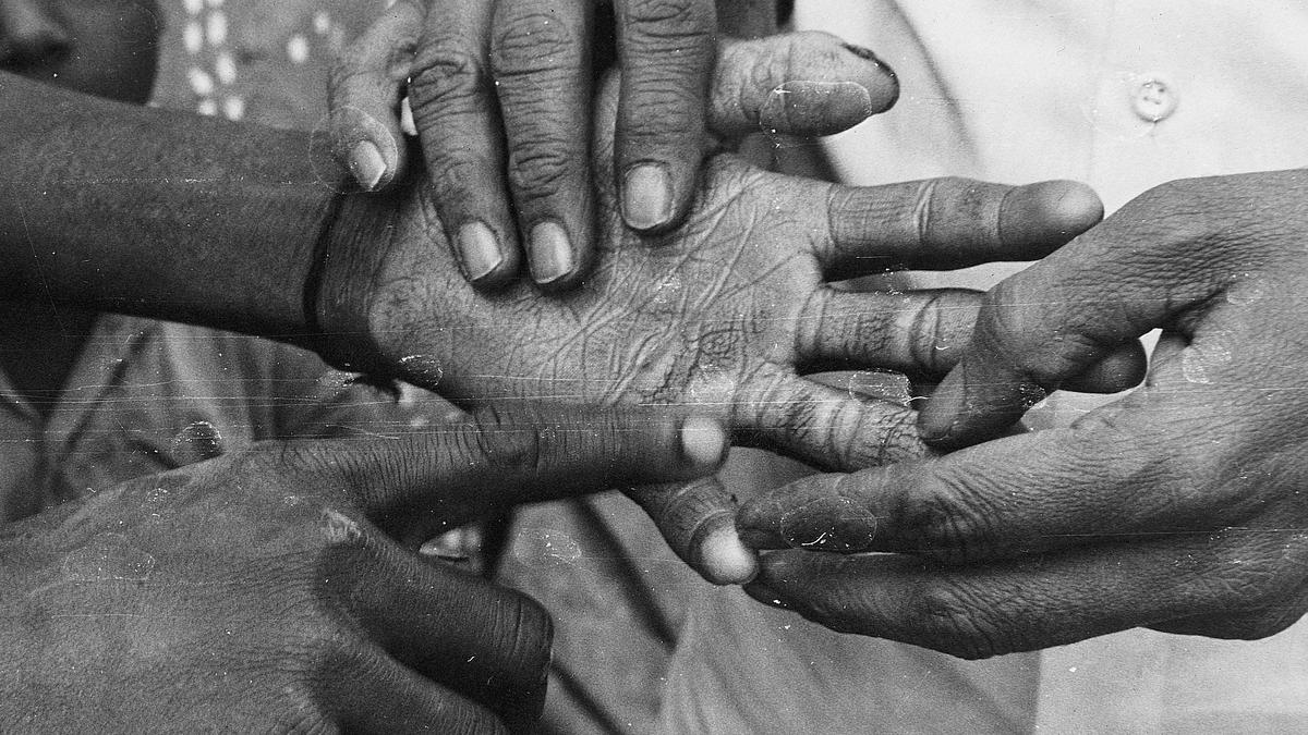‘Why did my son get this disease?’: of stigma, poverty and hard-fought battles against leprosy