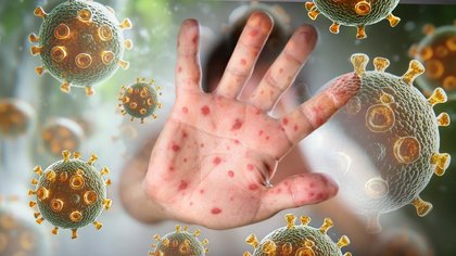 Pilbara measles outbreak: Two new cases confirmed by WA Health, hospitals among exposure sites
