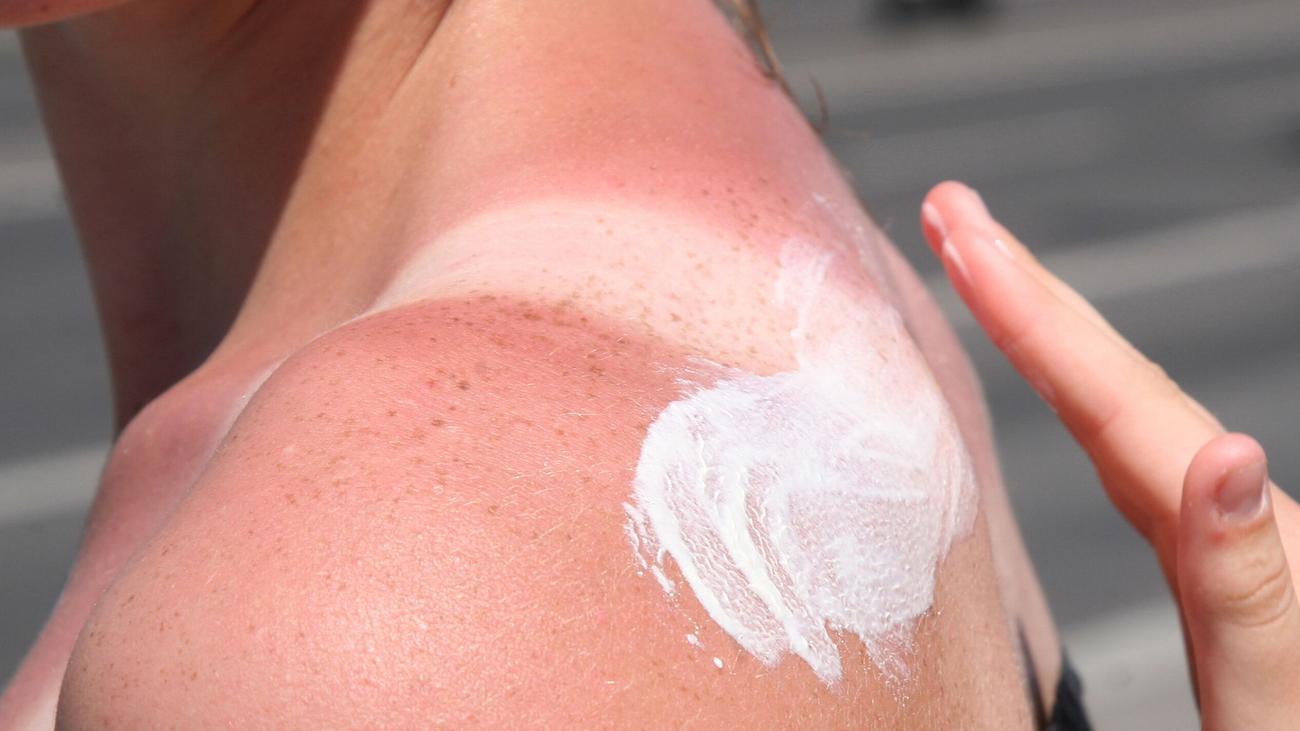 Warnung vor Sonnenbrand: «Tanmaxxing»-Trend: Experten warnen vor Sonnenbrand
