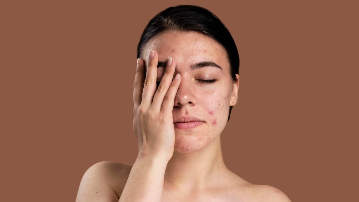 How to control acne and pigmentation naturally: Dermatologist-backed advice