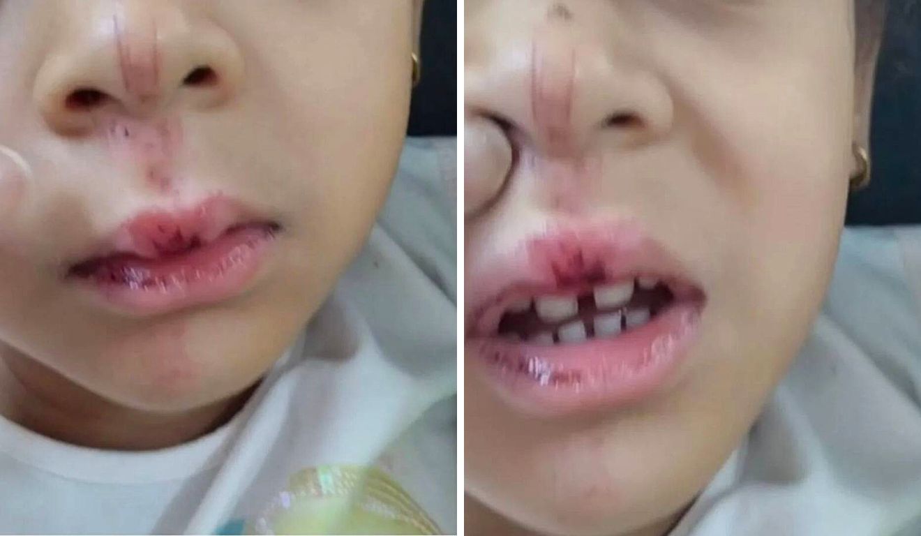 Criança de 4 anos é atropelada por bike elétrica na Praia da Costa