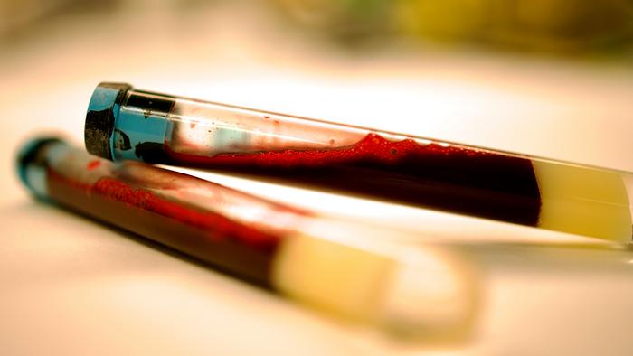 Blood Test Could Catch Parkinson’s Years Before Symptoms Strike