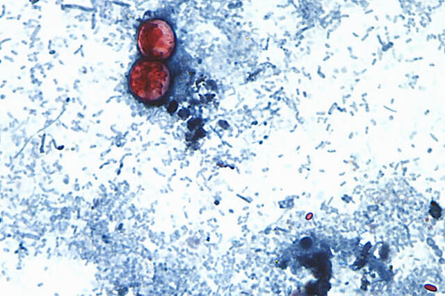 CDC: 15 states now linked to iceberg lettuce cyclospora outbreak