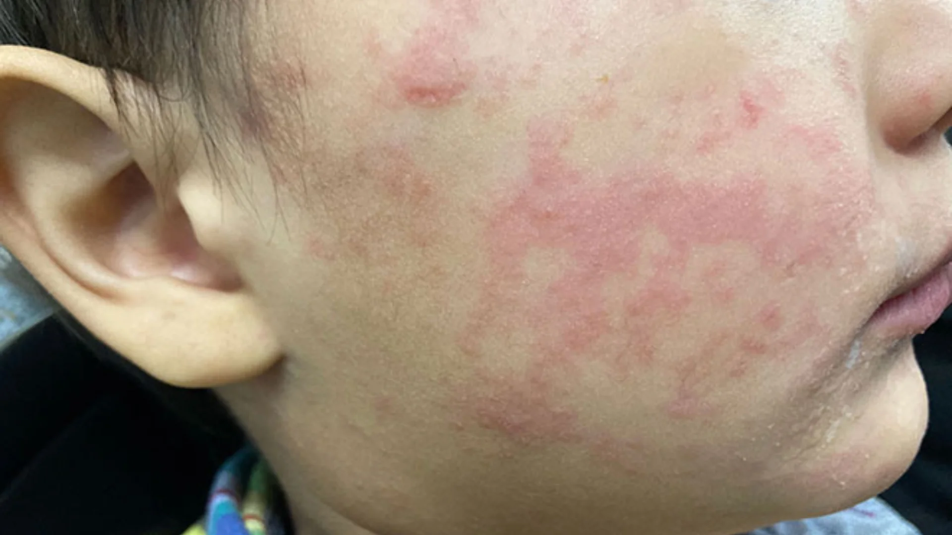 Knox County confirms measles case, urges vaccination and vigilance