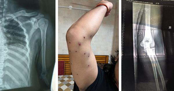 Delhi hospital reports show pellet wounds on journalist covering students’ protests