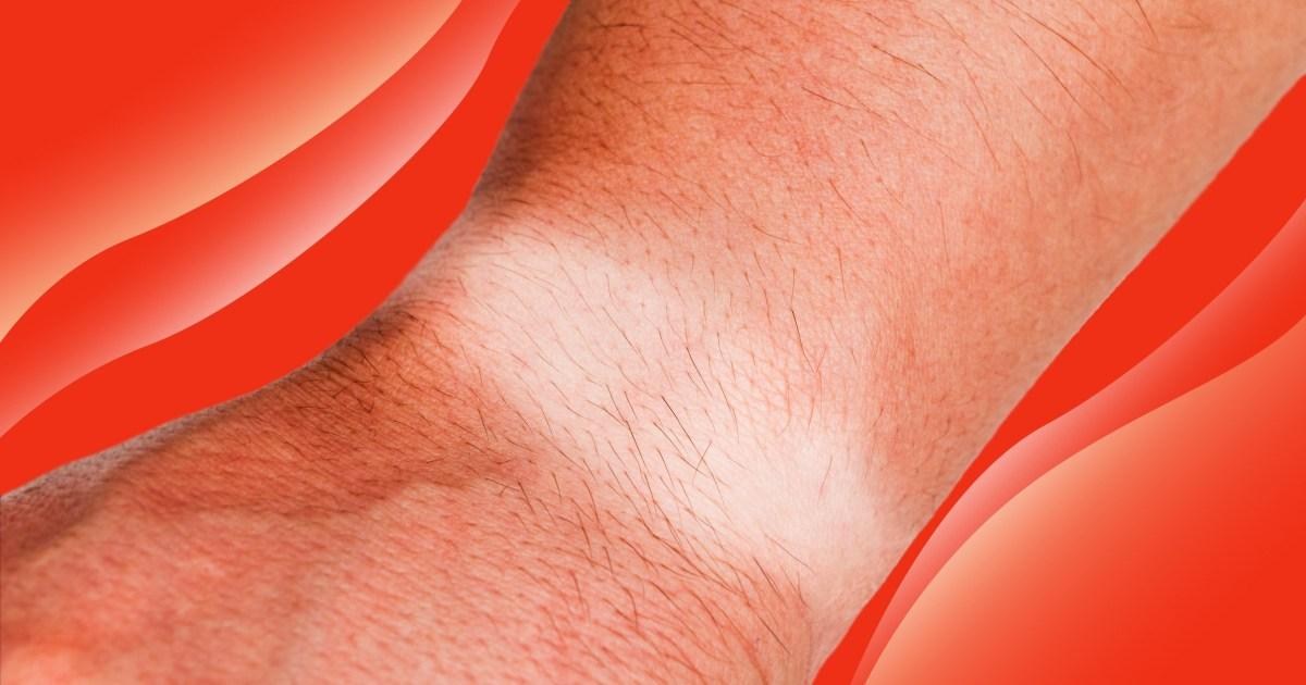 The ‘rotting’ summer wrist condition that keeps being mistaken for tan lines