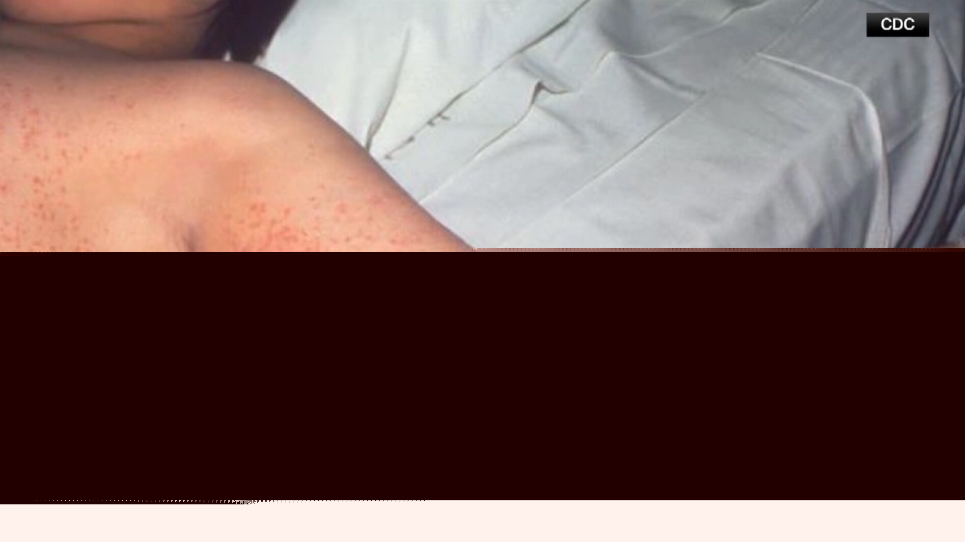 North Dakota measles cases rise as doctors urge vaccinations