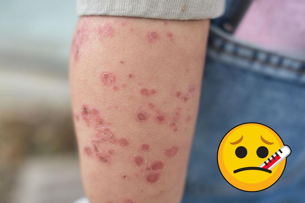 West Michigan Sees Increase In Hand Foot And Mouth Disease