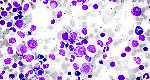 Genomic-based testing to transform care for multiple myeloma patients in Ireland