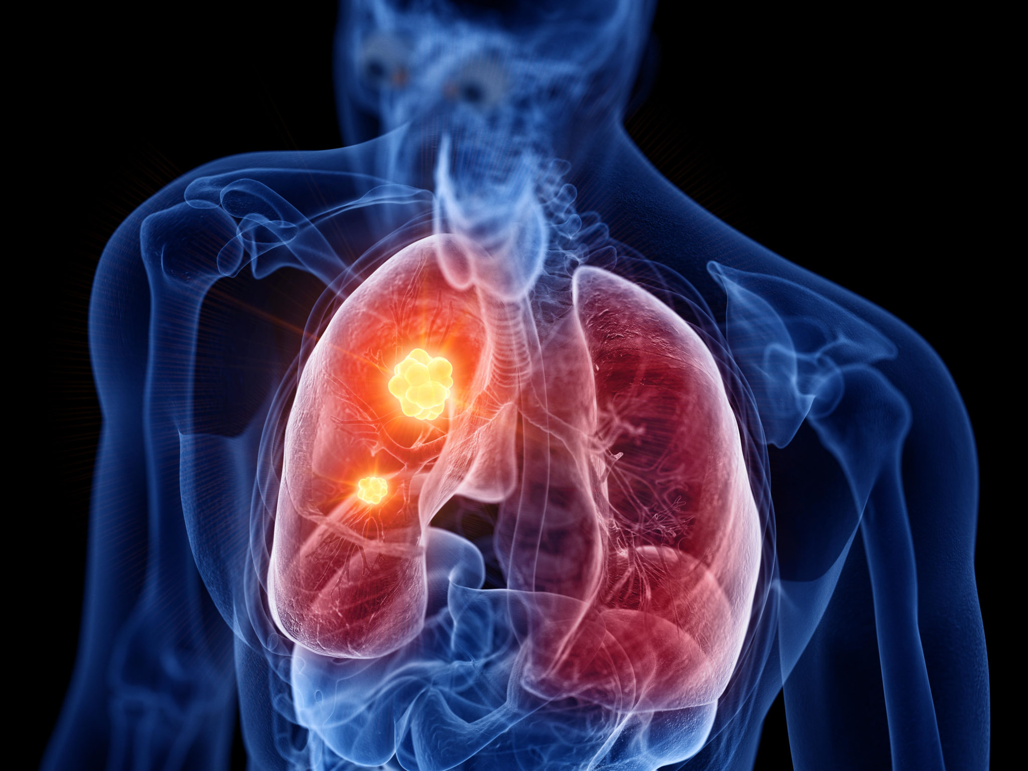 Dublin lung cancer survivor urges others to watch out for key symptoms