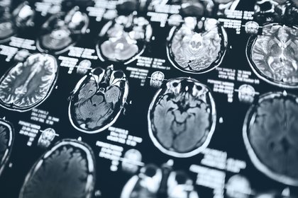 Non-invasive Approach Predicts Chemotherapy Response in Glioblastoma