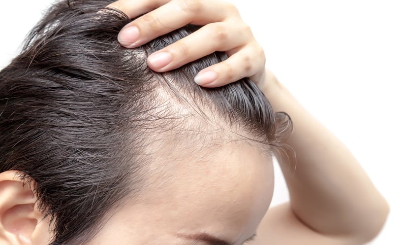Topical Finasteride Improved Male Pattern Hair Loss