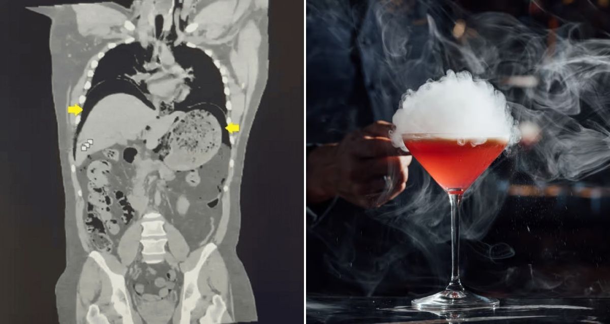 A Liquid Nitrogen-Infused Cocktail Caused A Man’s Stomach To Burst After He Drank It