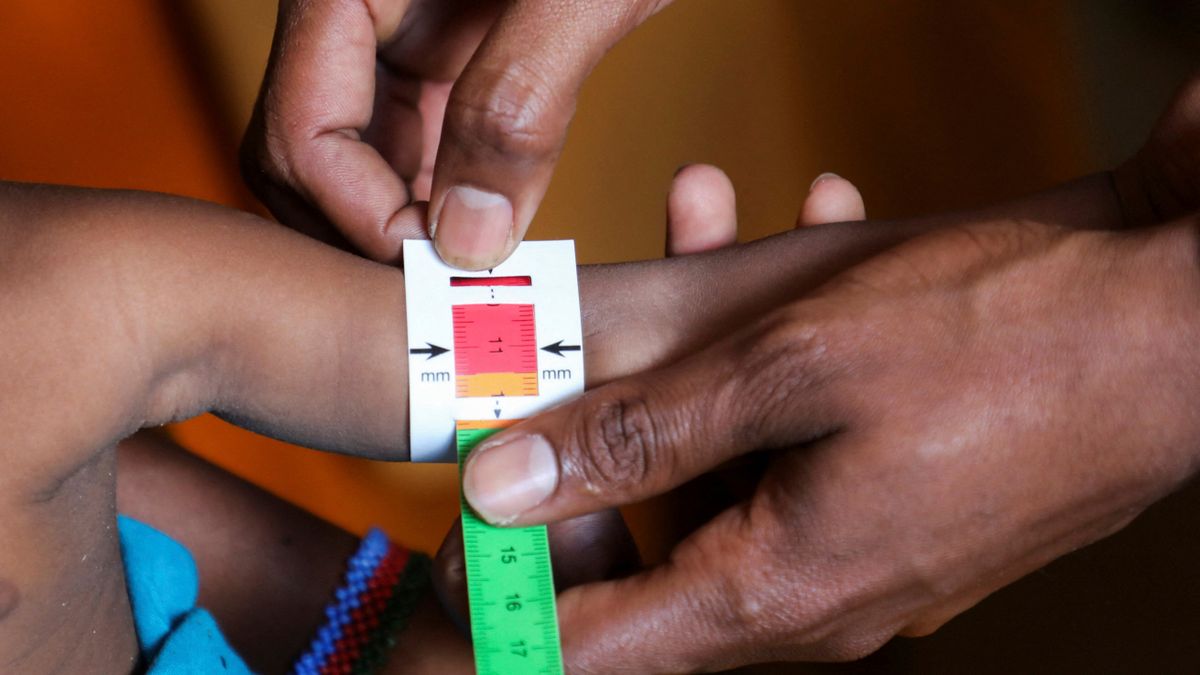 Somalia: Jedes zweite Kind ist laut Ärzte ohne Grenzen mangelernährt