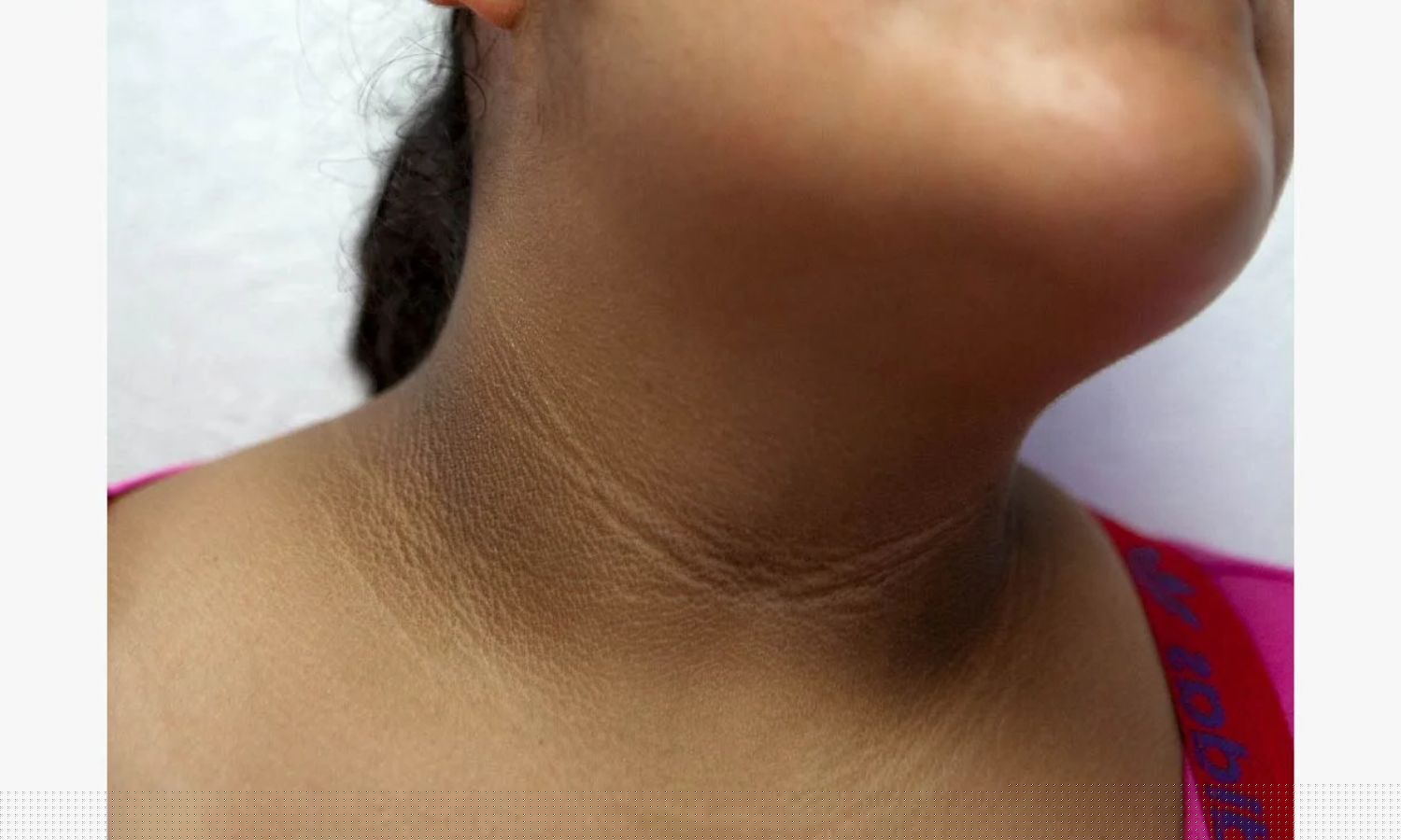 Sirolimus Gel Shows Promise for Acanthosis Nigricans, Suggests Study