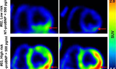 New therapy may reduce HF risk after heart attack
