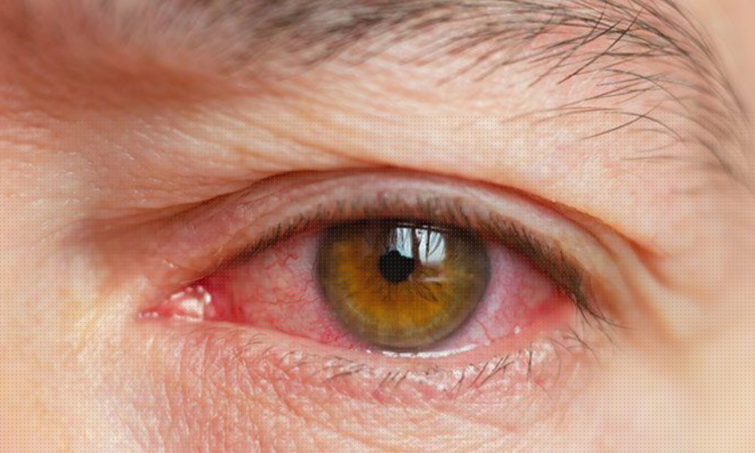 Early surgery for bacterial eye infection offers hope to patients: Study