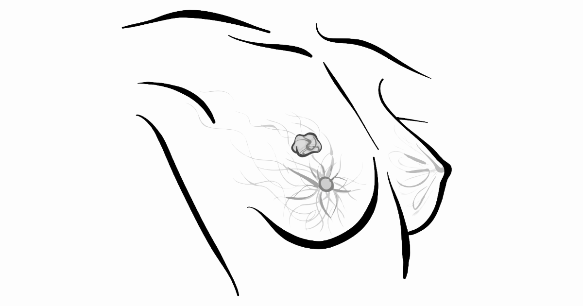 <![CDATA[NCCN Updates Breast Cancer Guidelines: Sacituzumab Govitecan for 1L TNBC]]>