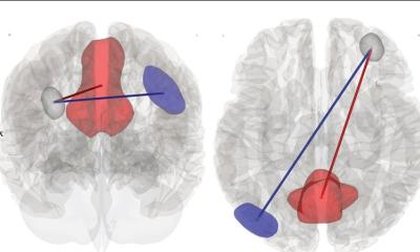 fMRI reveals why thinking feels so hard for ME/CFS and Long Covid patients