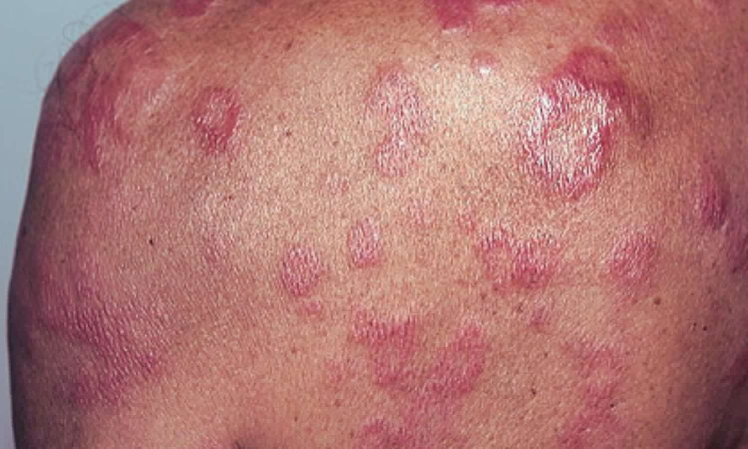 LRRK2 Gene Variants Influence Leprosy Risk and Immune Reactions, finds Systematic Review