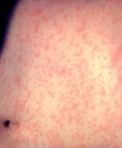 Oregon health officials warn of possible measles exposure at Clackamas Kaiser Permanente