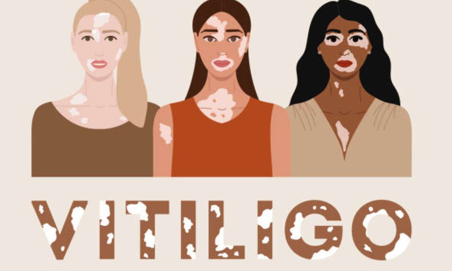 Phase III Trials Show Positive Results for Ritlecitinib in Nonsegmental Vitiligo
